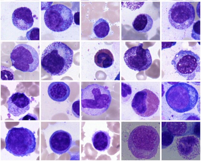 ساخت بزرگترین پایگاه داده سلول‌های مغز استخوان برای تشخیص بیماری‌های خونی