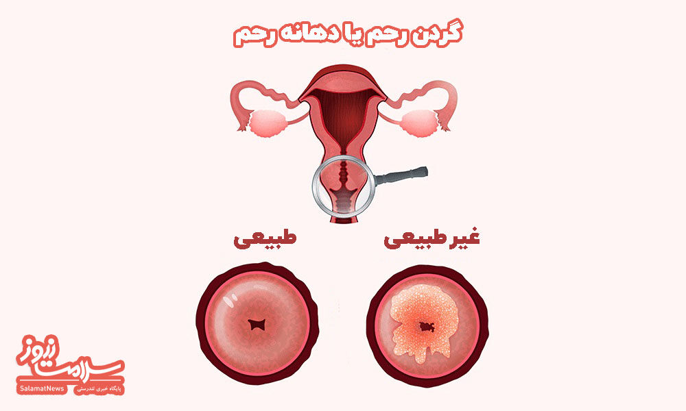 نحوه انجام آزمایش پاپ اسمیر و بهترین زمان انجام آن