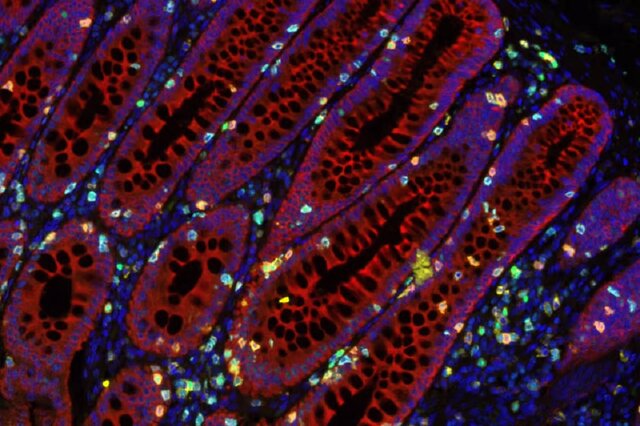 کشف نقشه‌ی راه برای غلبه بر سرطان روده