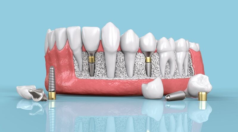 ایمپلنت دندان چیست؟ + آشنایی با انواع ایمپلنت