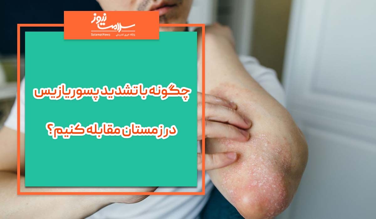 چگونه با تشدید پسوریازیس در زمستان مقابله کنیم؟