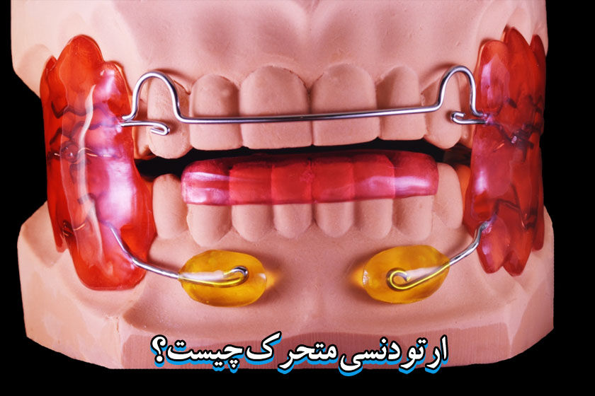 ارتودنسی متحرک چیست (مزایا و معایب + انواع)