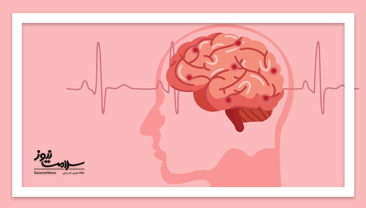 این علائم از سکته مغزی خبر می‌دهند +نسخه درمان