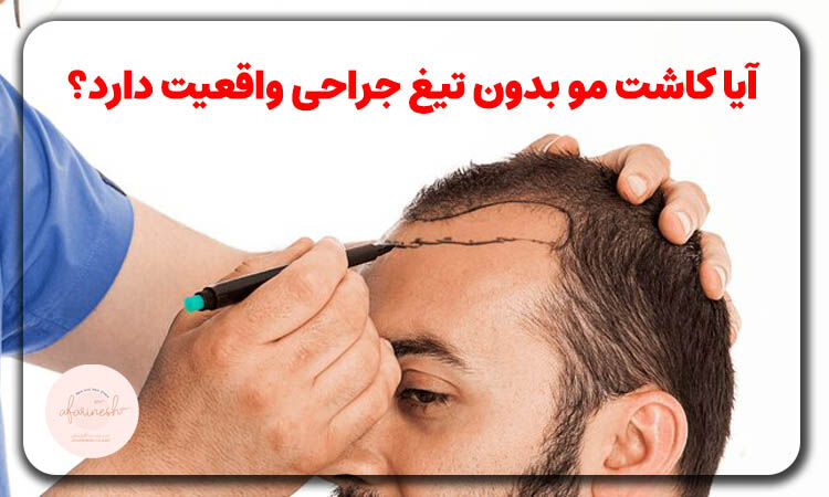 آیا کاشت مو بدون تیغ جراحی واقعیت دارد؟