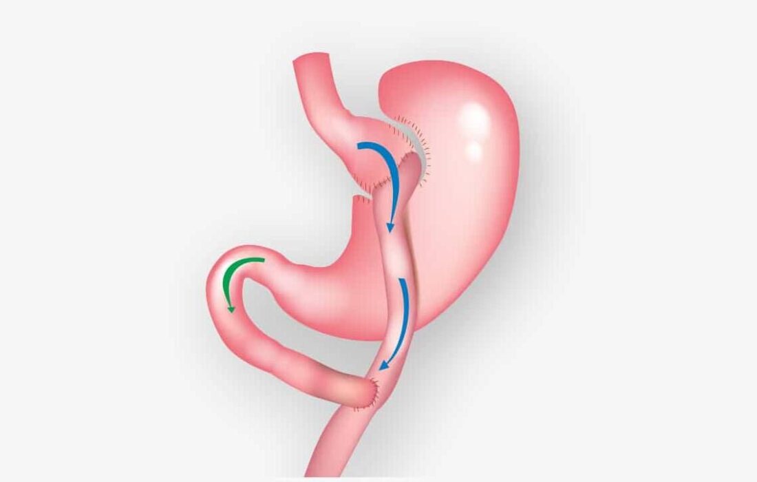 اسلیو معده: روشی موثر برای لاغری و کاهش وزن