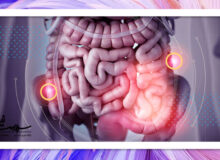 روند جهانی رو به رشد سرطان روده بزرگ در میان جوانان